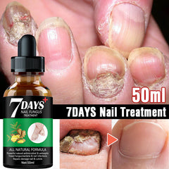 7DAYS Nail Fungus Treatment Serum Care Hand And Foot Care Removal